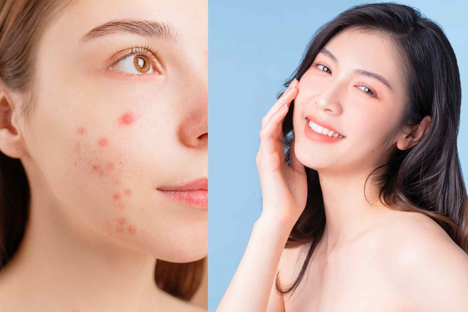 Acne Causes and Treatment: How to Get Clear Skin Naturally